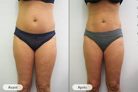 Institut-de-minceur-lyon-Cryolipolyse-Avant-Après-Un-Traitement-Contre-La-Cellulite-Efficace-C2