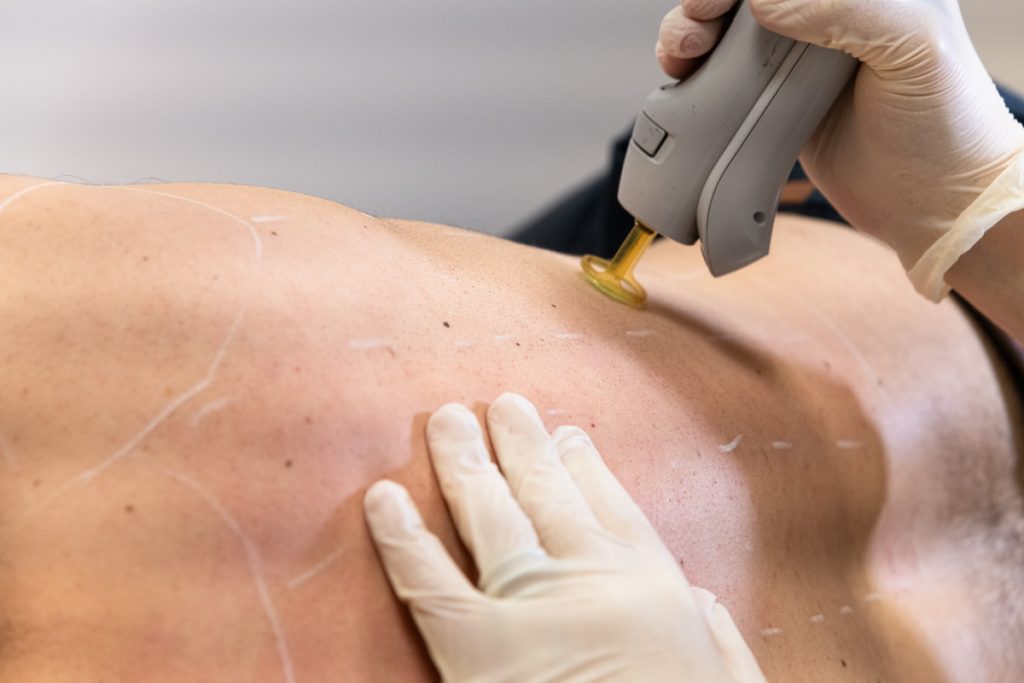 Institut-de-minceur-lyon-Les-methodes-d'epilation-definitive-pour-homme