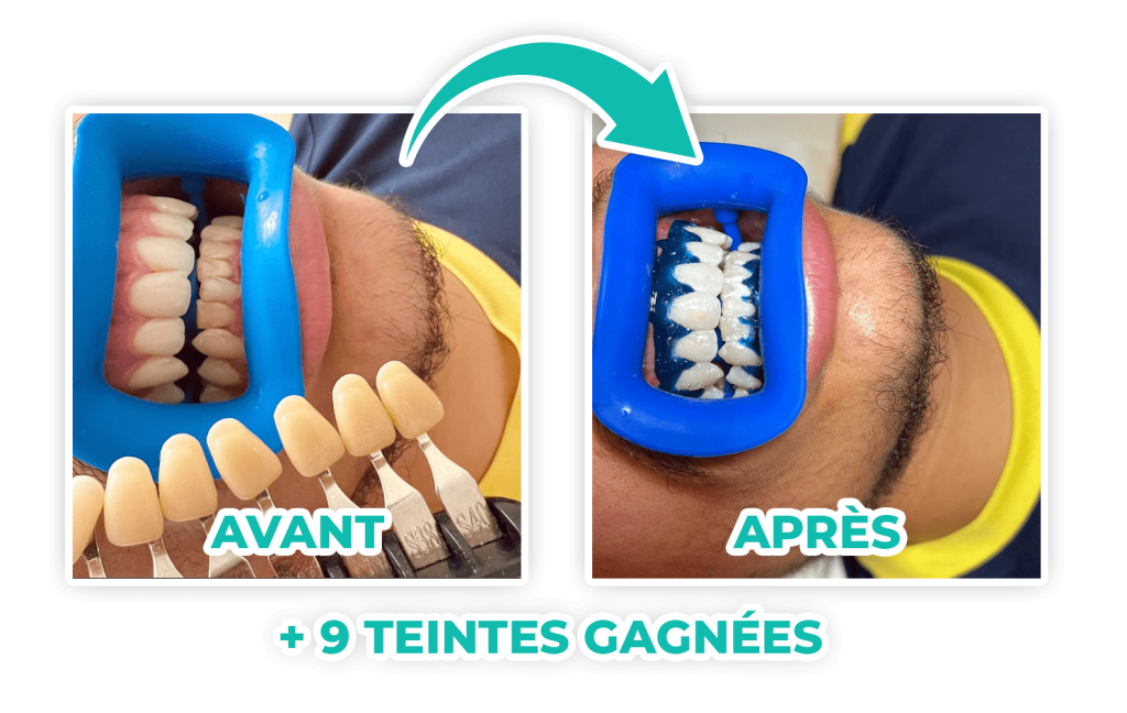 Blanchiment-dentaire-lyon-avant-apres-cryoinstitut_03