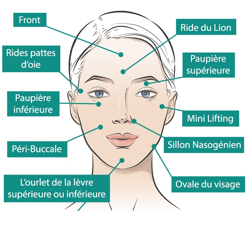 Choix-des-zones-plasma-lift-cryoinstitut-lyon