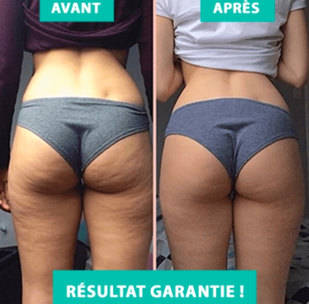 beneficiez-d-un-traitement-anti-cellulite-efficace-a-lyon-et-villeurbanne