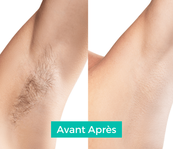 epilation-lumiere-pulsee-avant-apres-cryoinstitutl-lyon